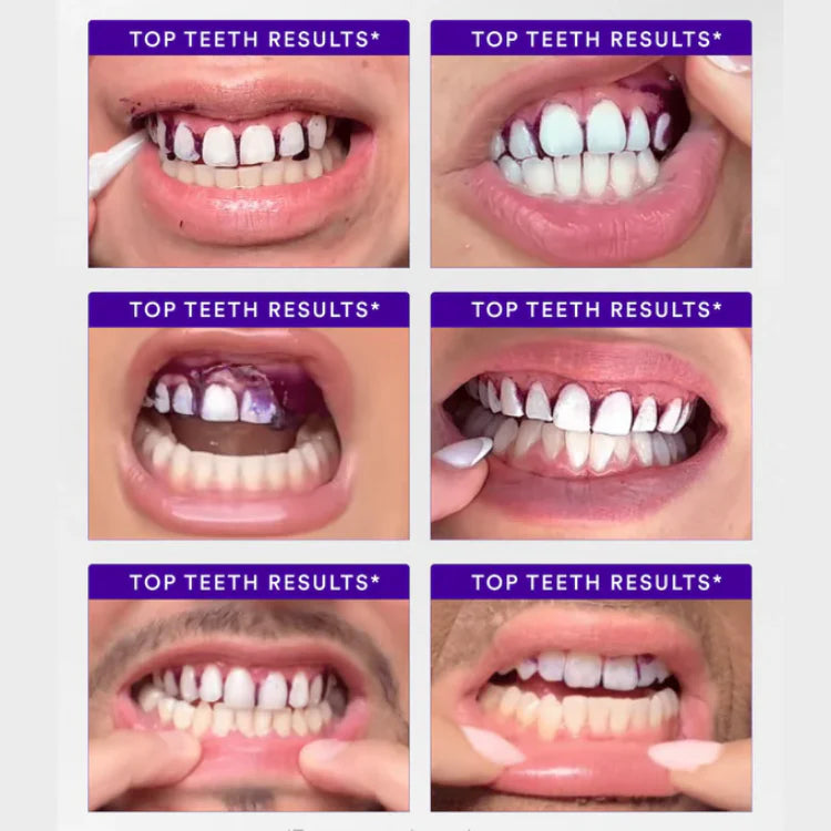 Purple Whitening Strips